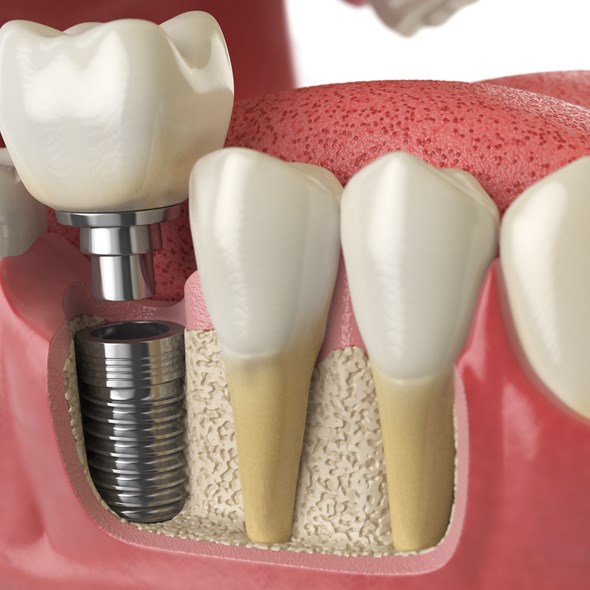 Cirurgia Oral  & Implantologia