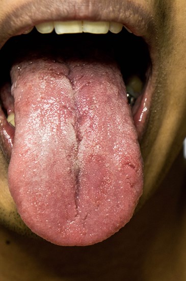 Consulta de Xerostomia  (falta de saliva)