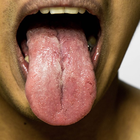 Consulta de Xerostomia (falta de saliva)